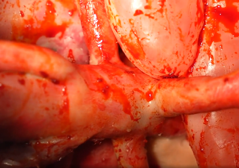 胸腹部損傷控制手術(shù)模擬人系統3.0